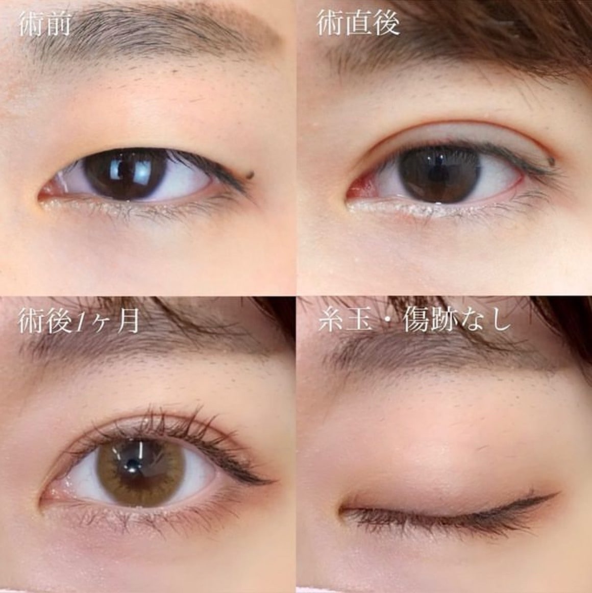 Days二重術症例1