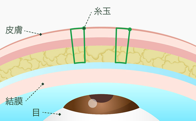スタンダード法 瞼板法2点留めイメージ