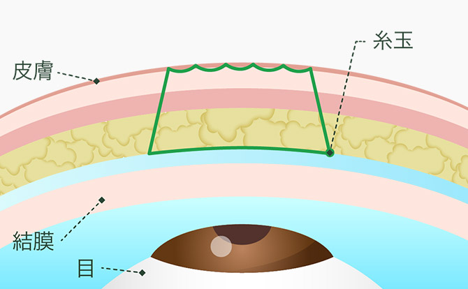 Days式シークレットシングル 瞼板法2点留めイメージ