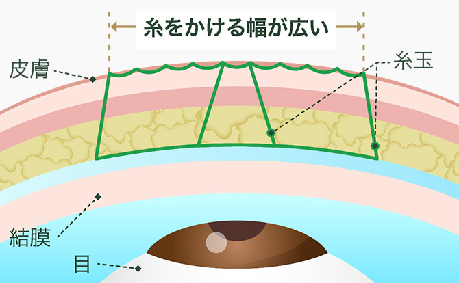 Days式シークレットダブル　瞼板法2点留めイメージ